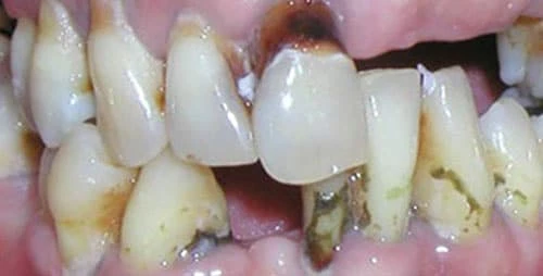 dental implants case 1 before