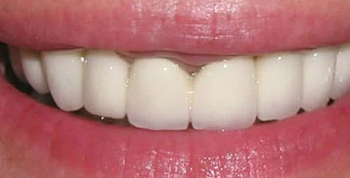 dental implants case 2 after