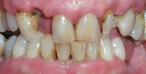 dental implants case 2 before