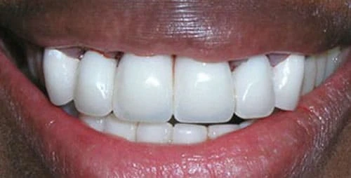 dental implants case 3 after