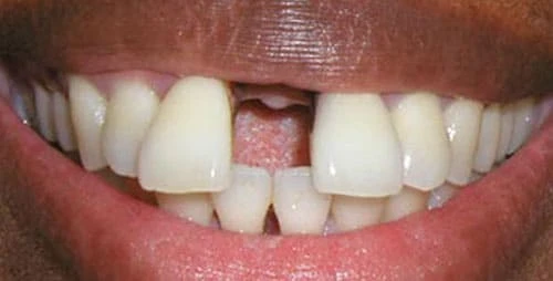 dental implants case 3 before