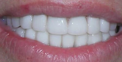 full mouth reconstruction case 1 after