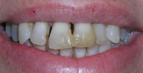 full mouth reconstruction case 1 before