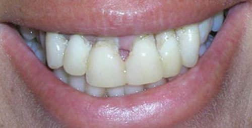 full mouth reconstruction case 2 before