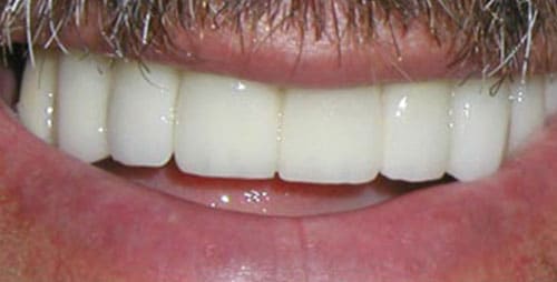 full mouth reconstruction case 4 after 4