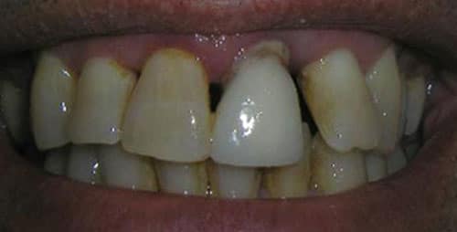 full mouth reconstruction case 4 before 4