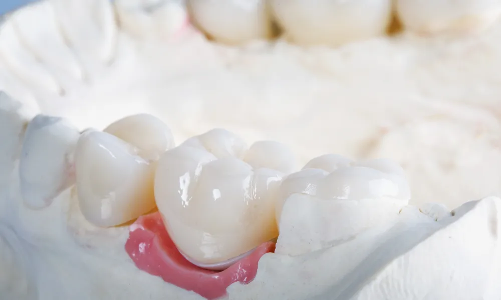 dental crown placement restoring damaged tooth greenacres fl