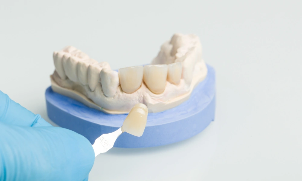 veneer application on teeth cosmetic dentistry greenacres fl