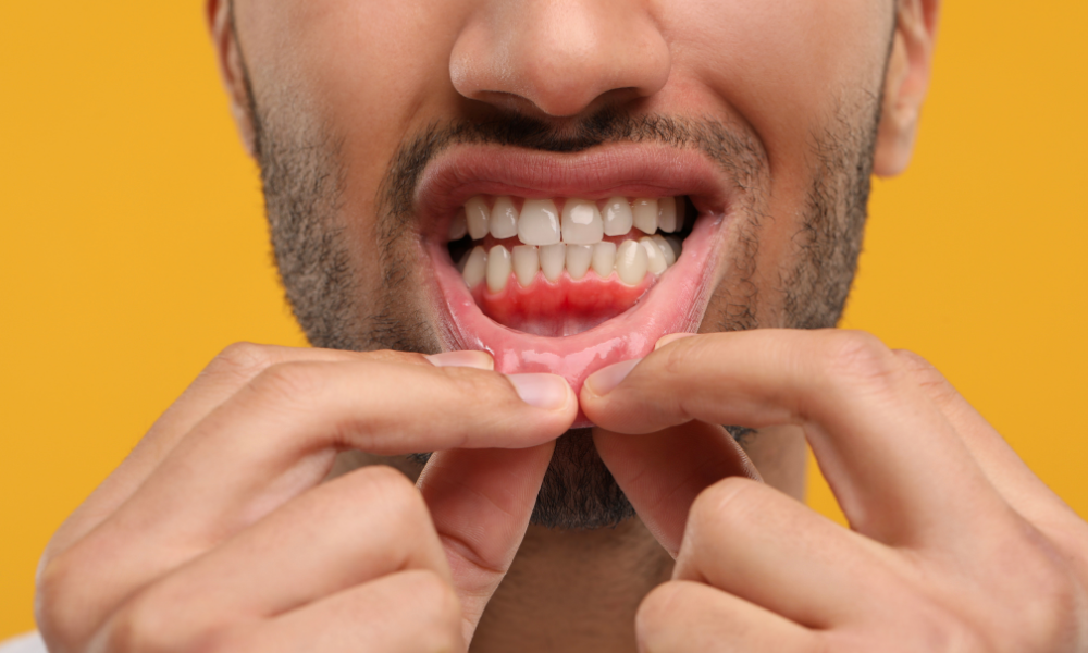 man pulling down lower lip to show receding gums and gum irritation near the teeth