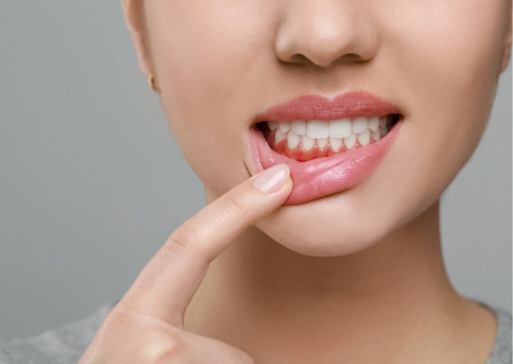 Close-up of swollen gums near a tooth, illustrating symptoms that may require dental abscess self care and professional treatment