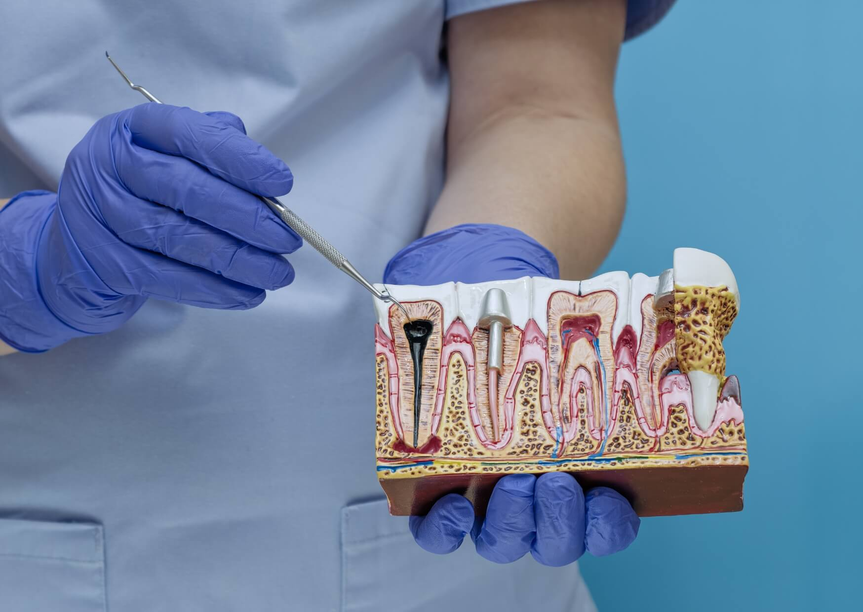 Dental model showing an infected tooth with deep decay reaching the pulp and surrounding root structures.