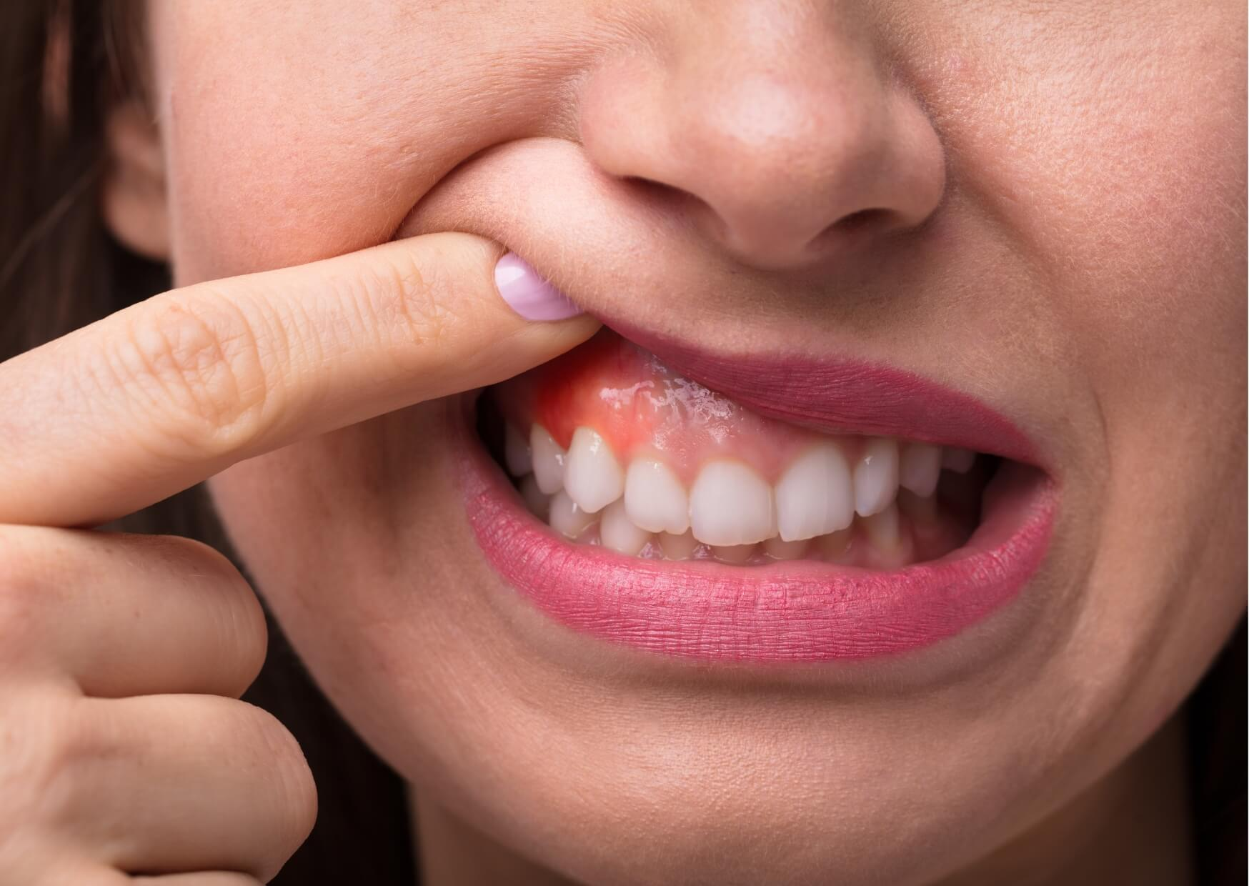 Close-up of swollen, red gums demonstrating gingivitis before treatment to improve gum health.