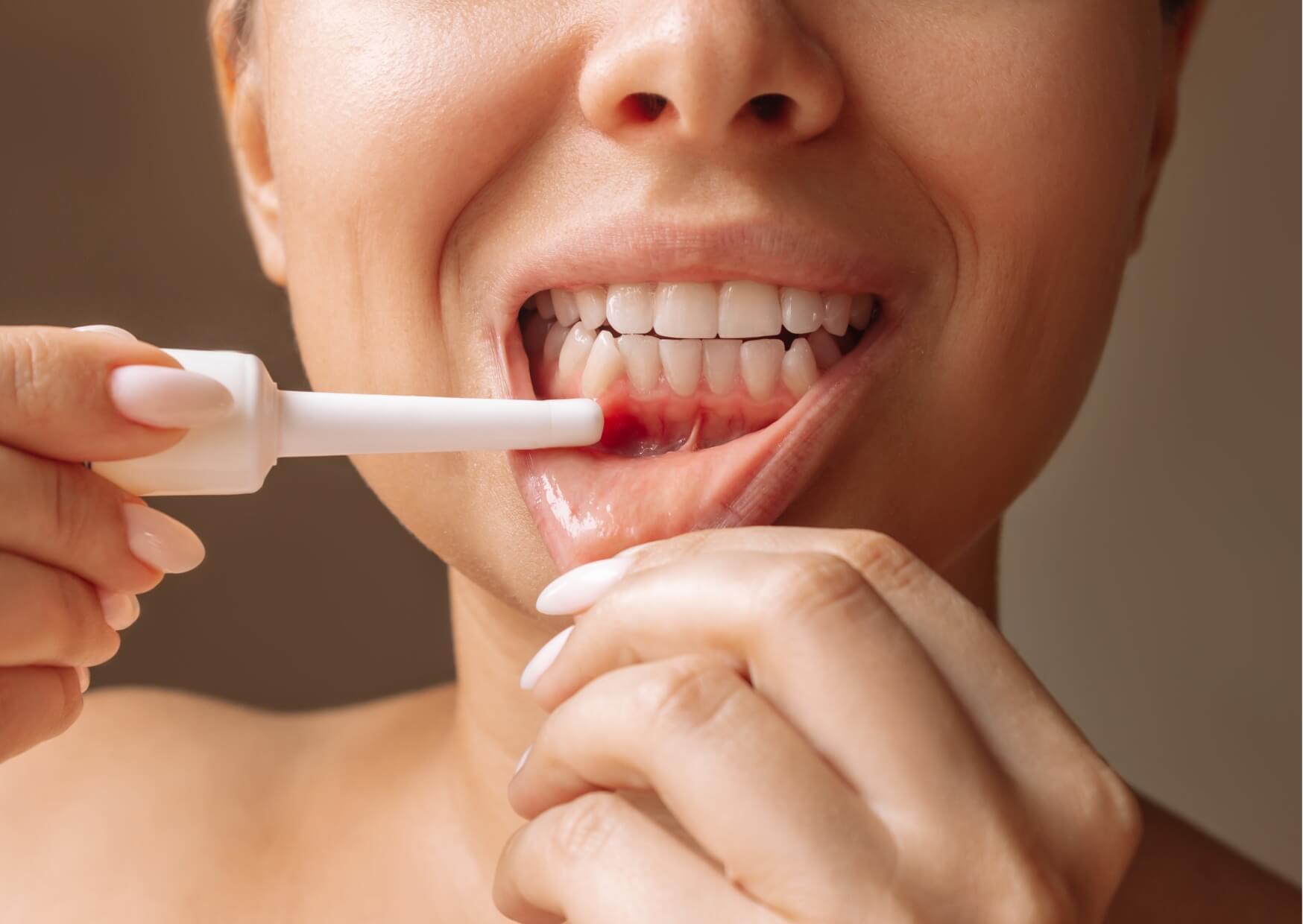 Close-up of red, swollen gums with bleeding, illustrating common signs and symptoms of gingivitis.