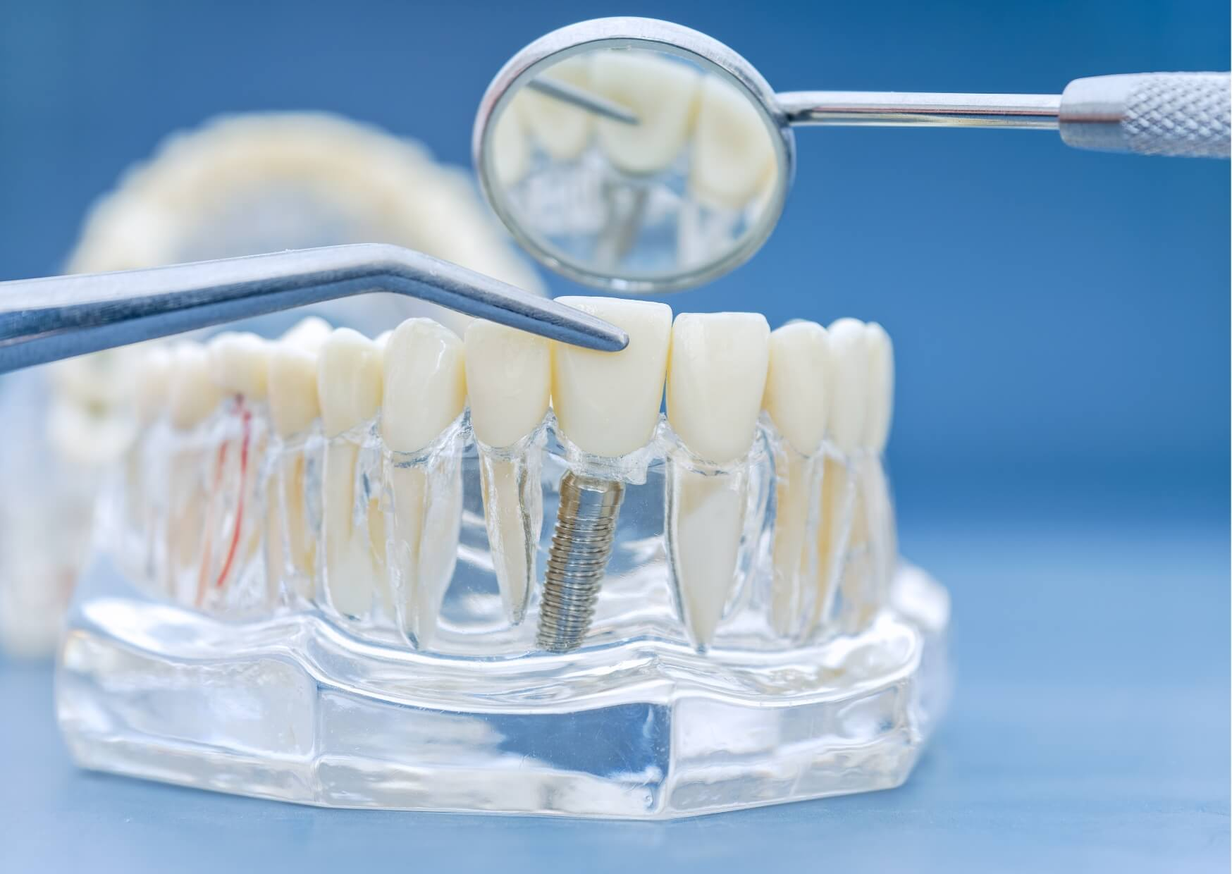 Dental implant model showing a restored tooth, illustrating that many adults are still candidates for dental implants later in life.