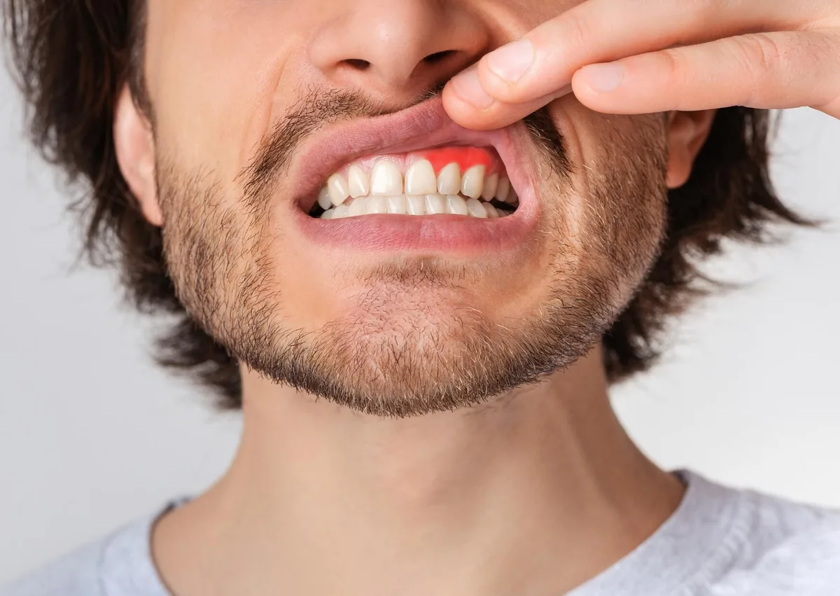 Person showing swollen, enlarged gums associated with gingival hyperplasia.