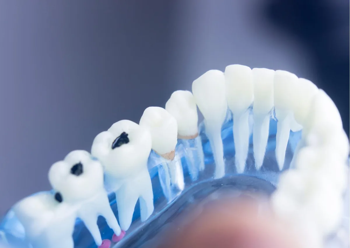 Dental model showing plaque buildup on teeth and areas that require thorough plaque removal.