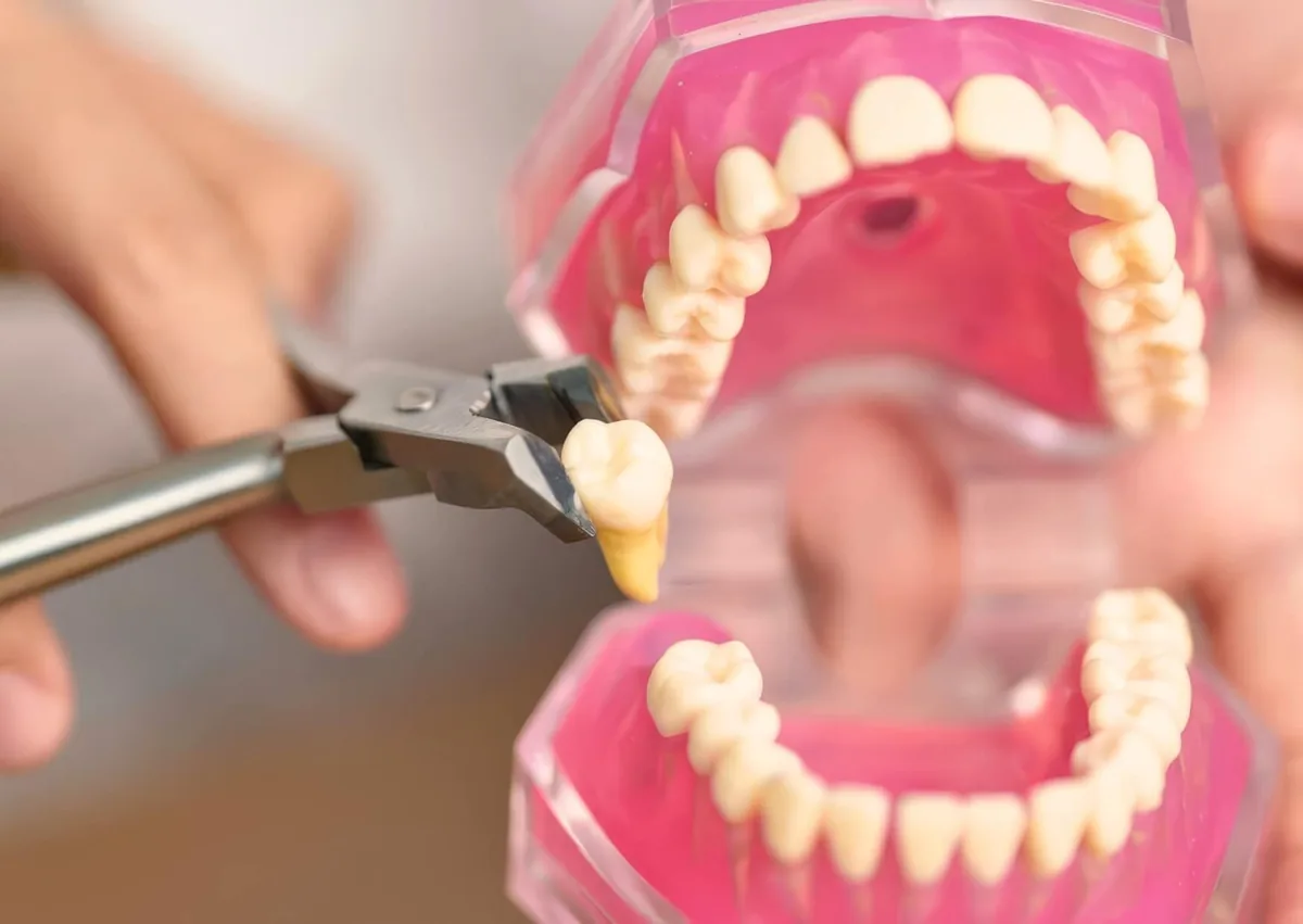 Dental model demonstrating wisdom tooth removal when planning what to eat during recovery.