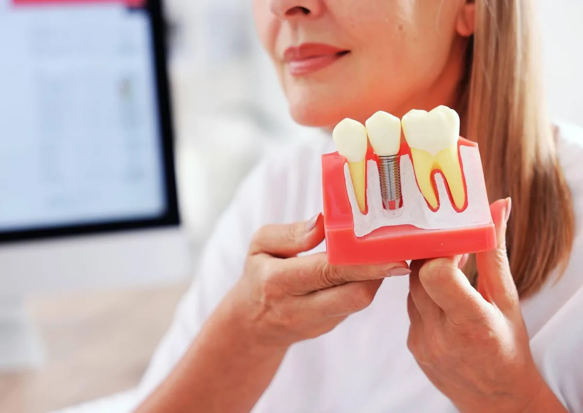 Dental implant model showing a tooth replacement option for patients considering affordable dental implants.