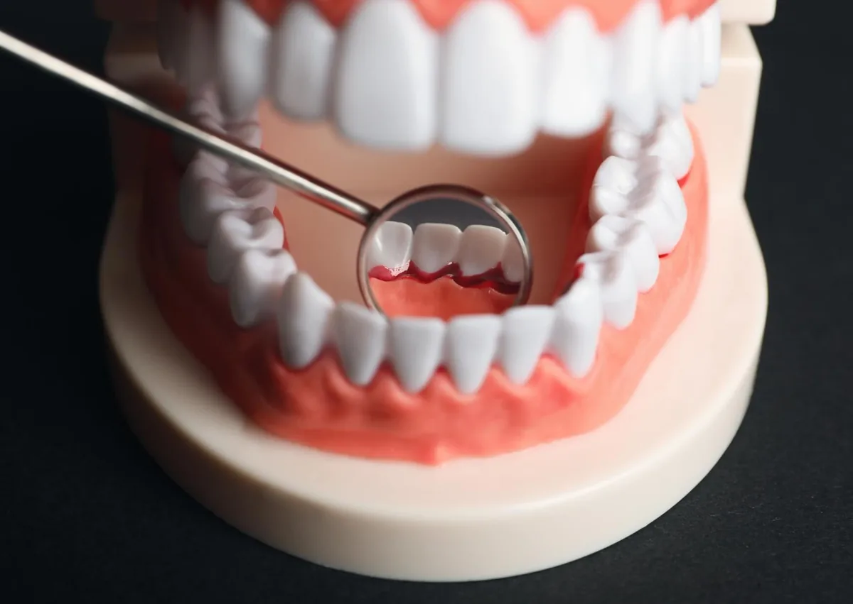 Dental model showing inflamed gums to illustrate the differences between gingivitis and periodontitis.