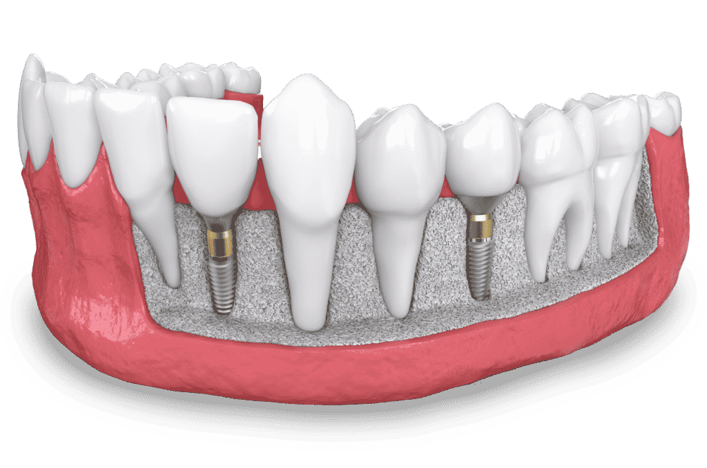 Implants image