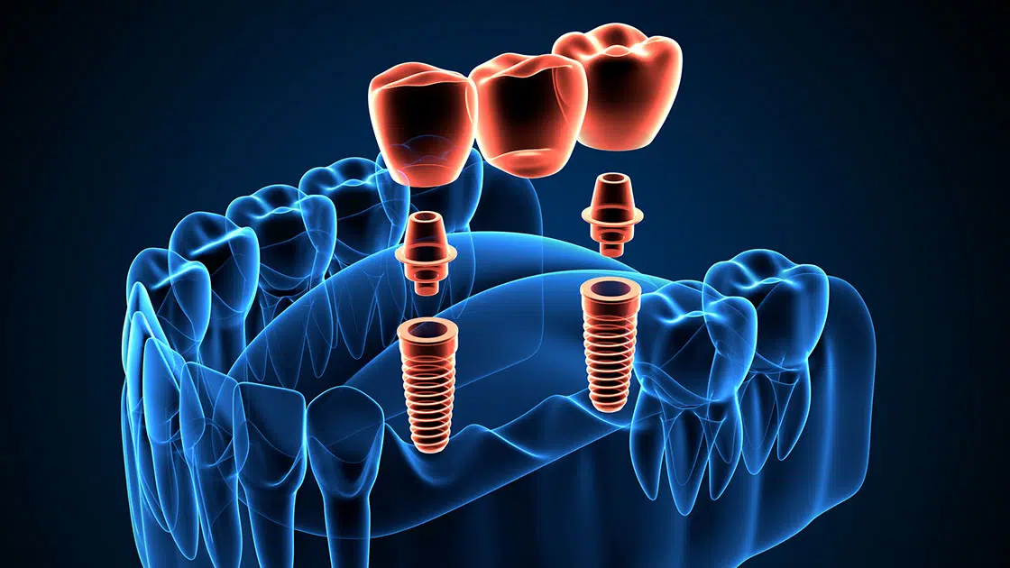 Implant Supported Bridge Illustration