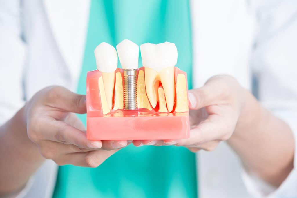 What Is The Cost Of Dental Implants In South Florida?