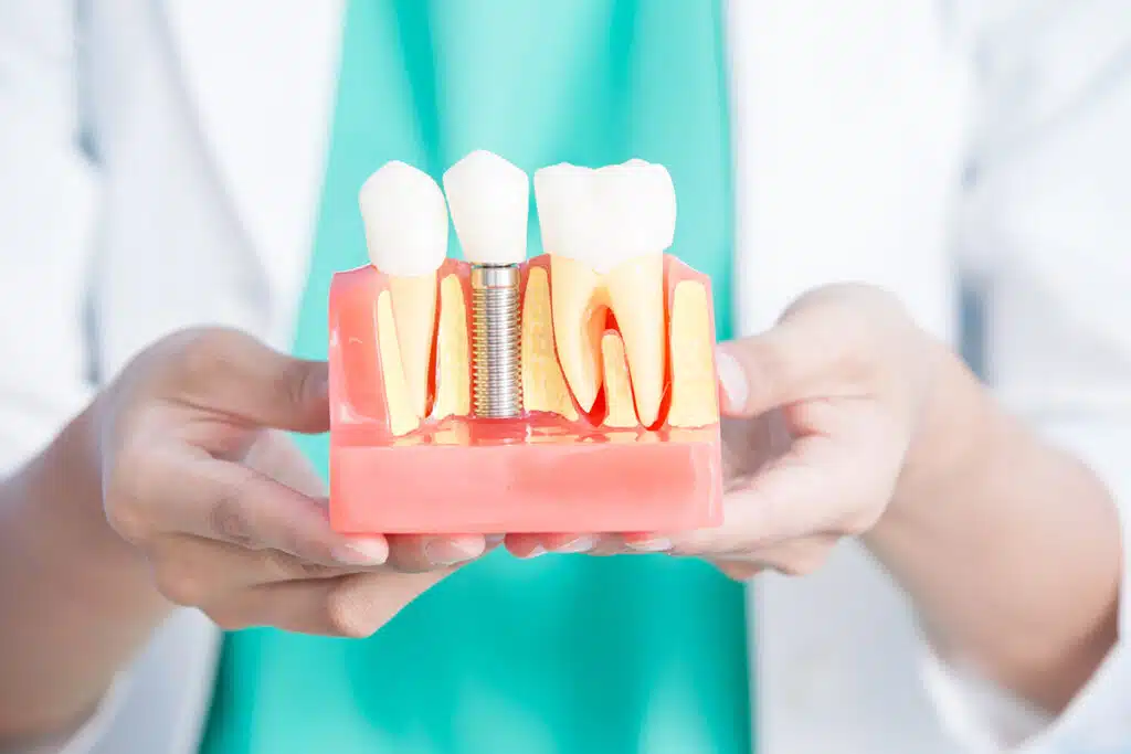 What Is The Cost Of Dental Implants In South Florida?